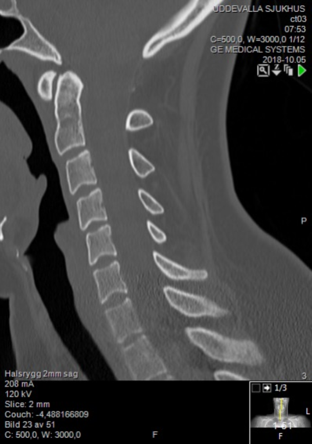 Ein Röntgenbild eines Mannes mit einem sichtbaren Bruch in der Mitte, das auf einem Computerbildschirm mit Text und Zahlen angezeigt wird.